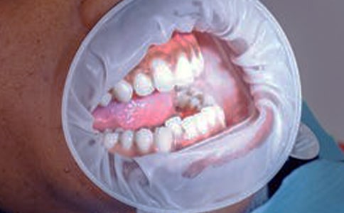 ���ǳݵ��µ�������ʹ��ô��