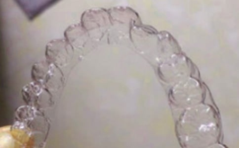 再次换牙套感受初中作文